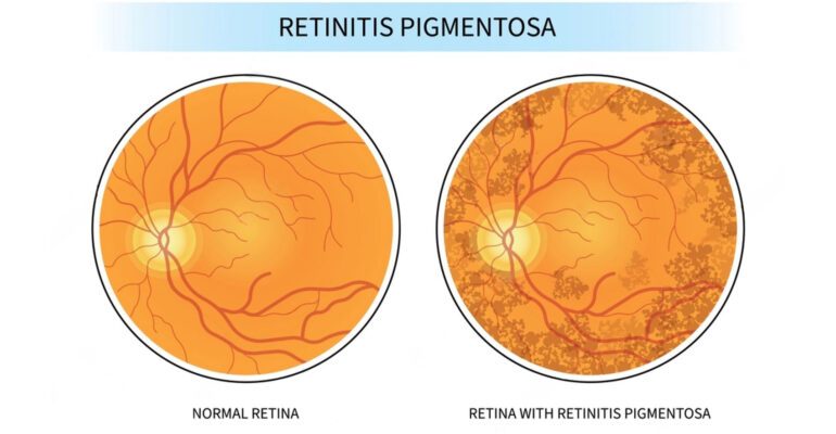 Retinitis_Pigmentosa