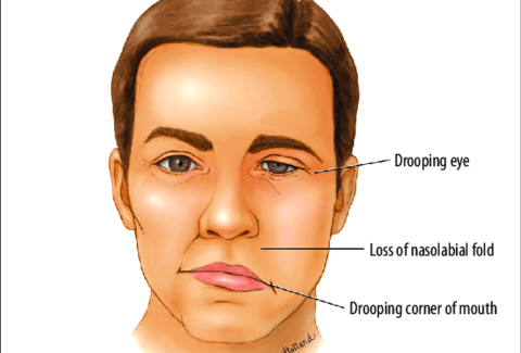 bell's palsy